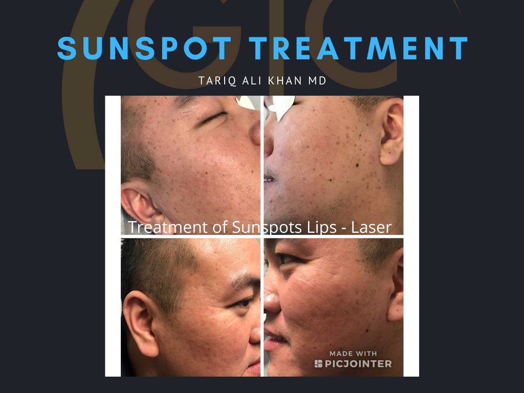 Gentle Care Laser Tustin & Long Beach Before and After picture - Sunspot treatment